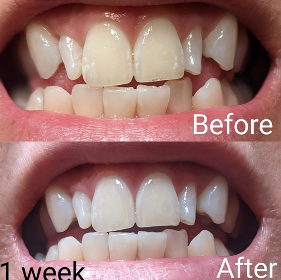 Hismile V34 Color Corrector Toothpaste 30ml photo review